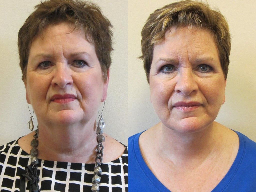 Face Lift Before & After