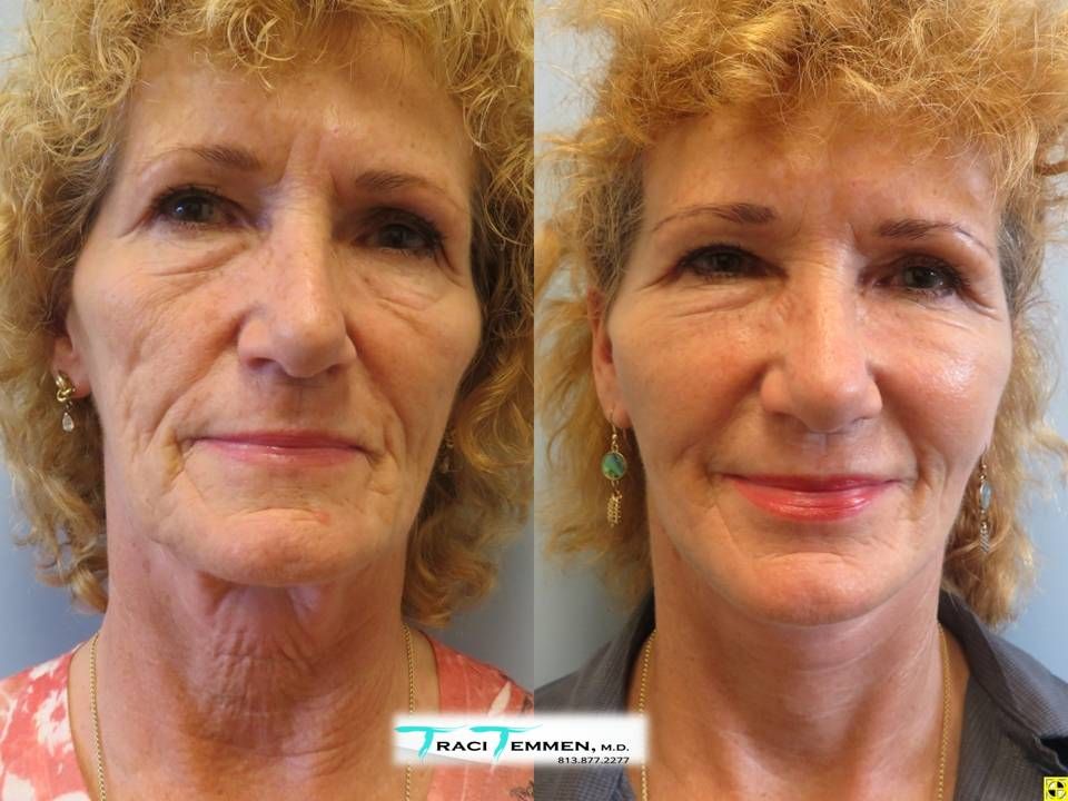 Face Lift Before & After