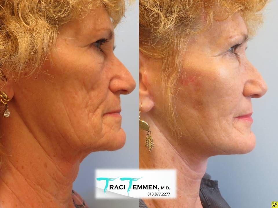 Face Lift Before & After