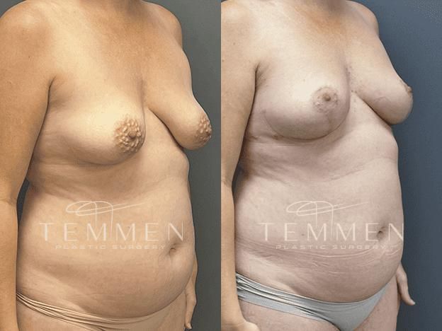 Breast Asymmetry Before & After