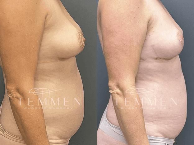 Breast Asymmetry Before & After