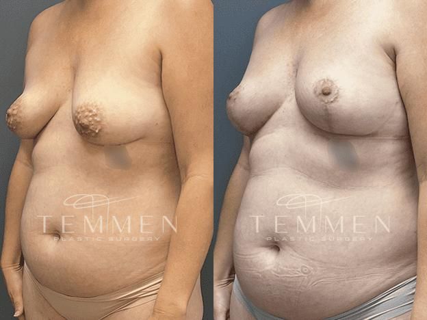 Breast Asymmetry Before & After