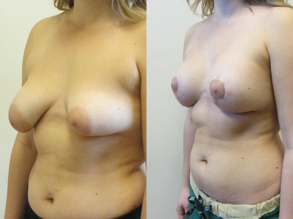 Breast Asymmetry Before & After