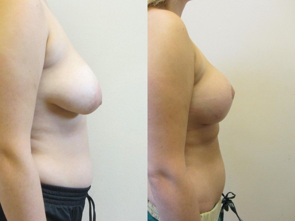 Breast Asymmetry Before & After