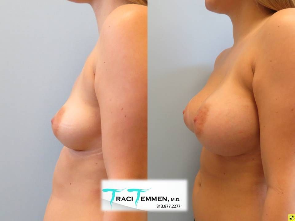 Breast Asymmetry Before & After