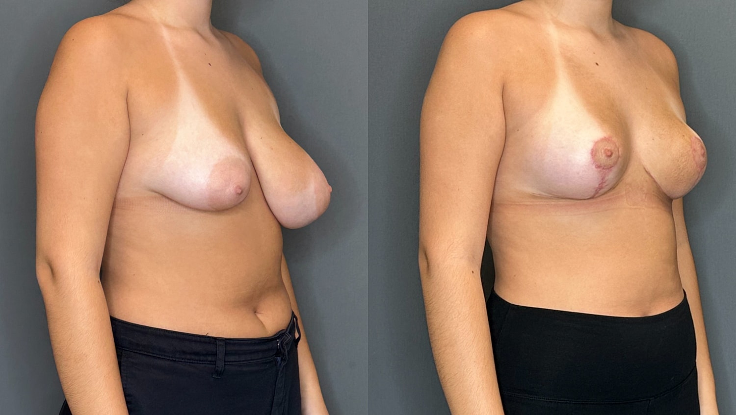 Breast Asymmetry Before & After