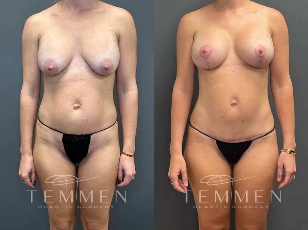 Mommy Makeover Before & After