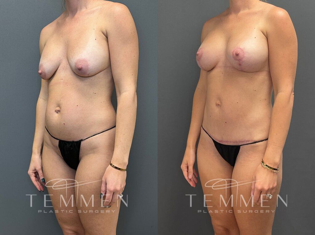 Mommy Makeover Before & After