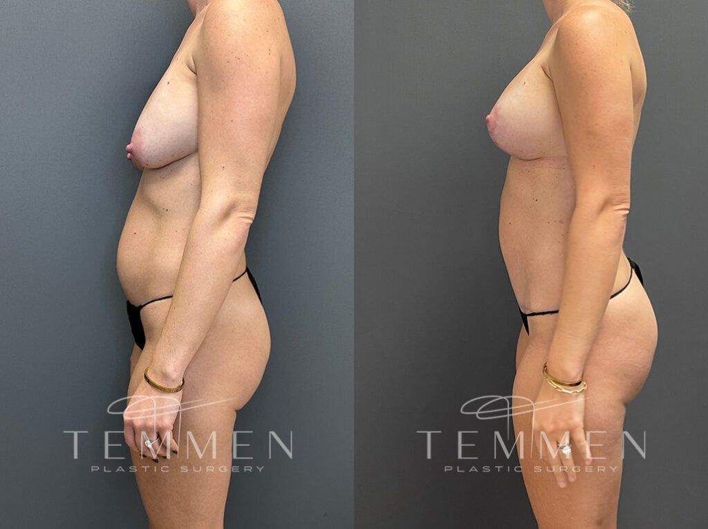 Mommy Makeover Before & After