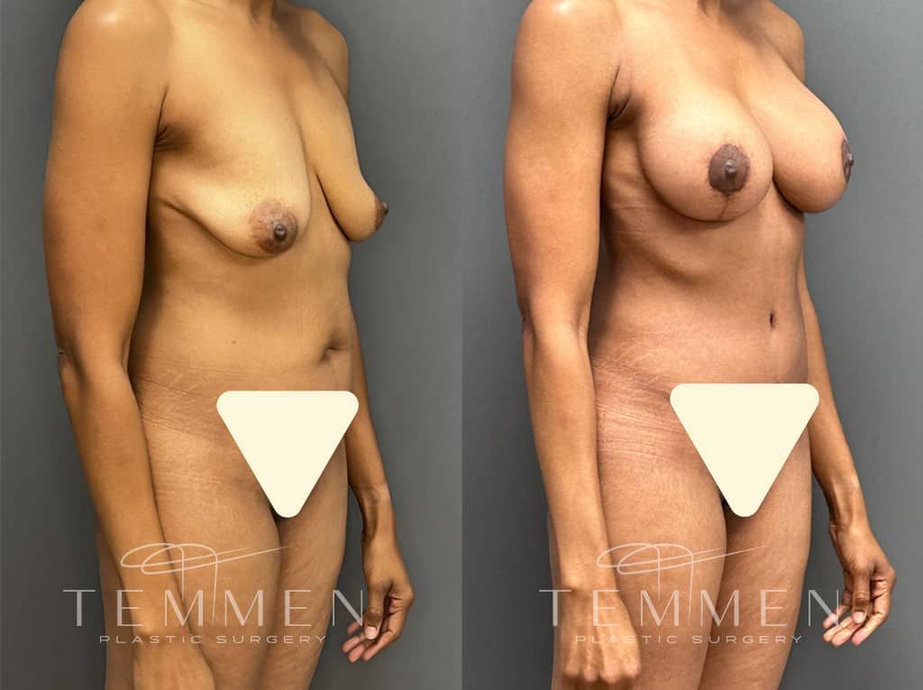 Mommy Makeover Before & After