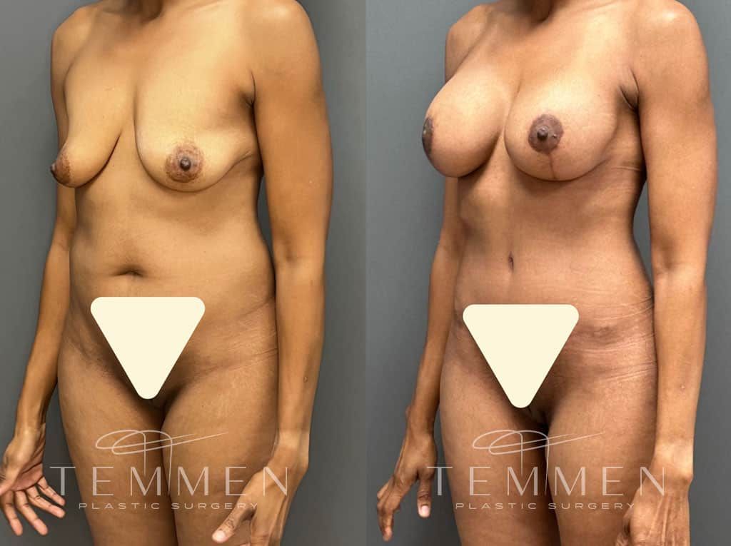 Mommy Makeover Before & After