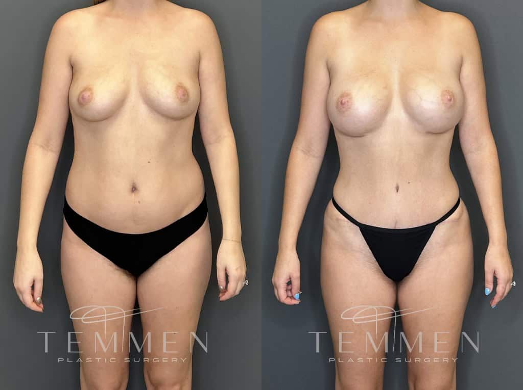 Mommy Makeover Before & After