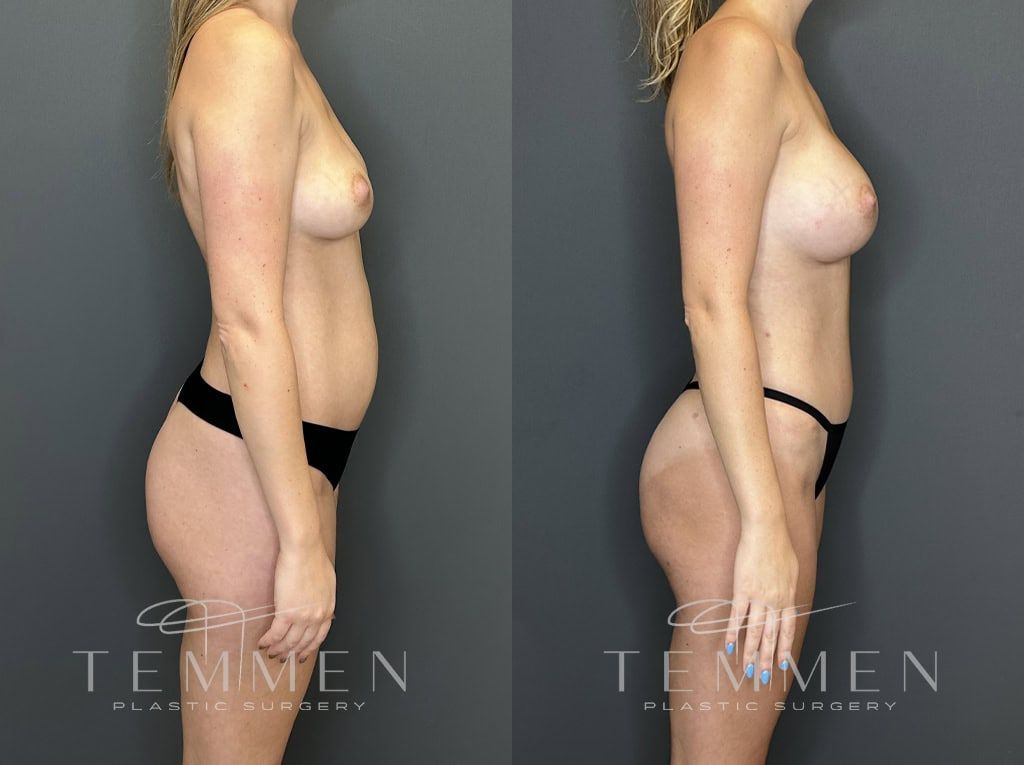 Mommy Makeover Before & After