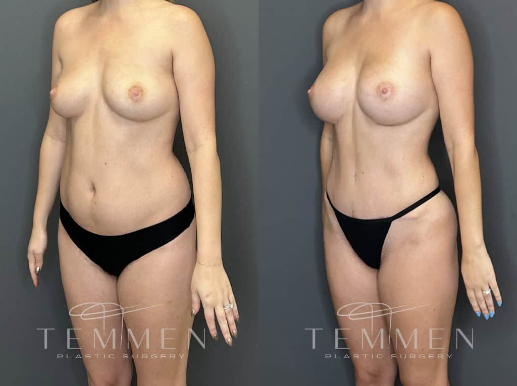 Mommy Makeover Before & After