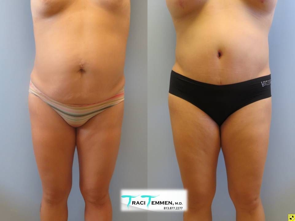 Mommy Makeover Before & After