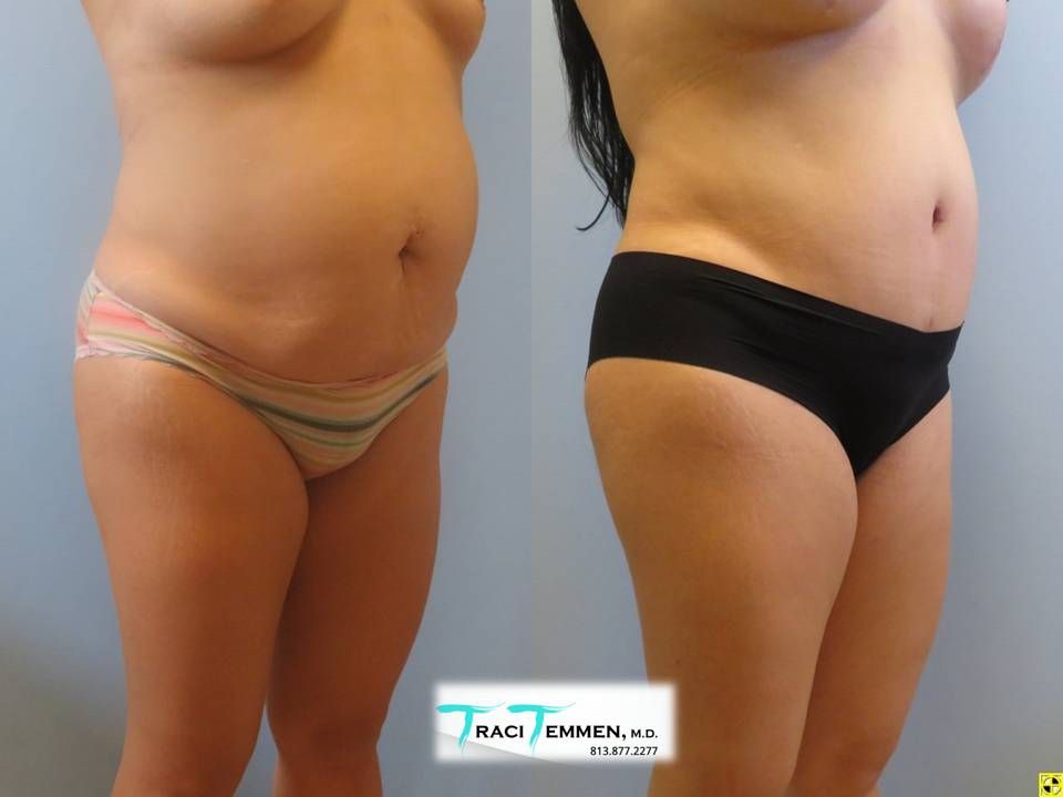 Mommy Makeover Before & After