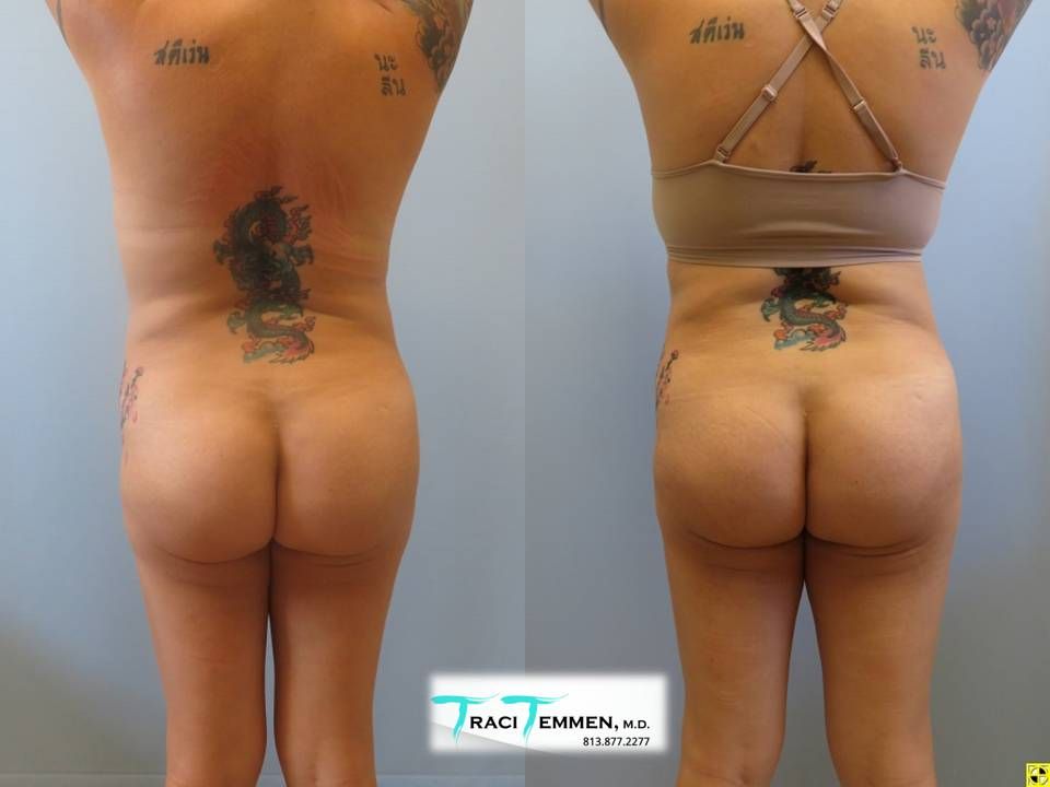 Mommy Makeover Before & After