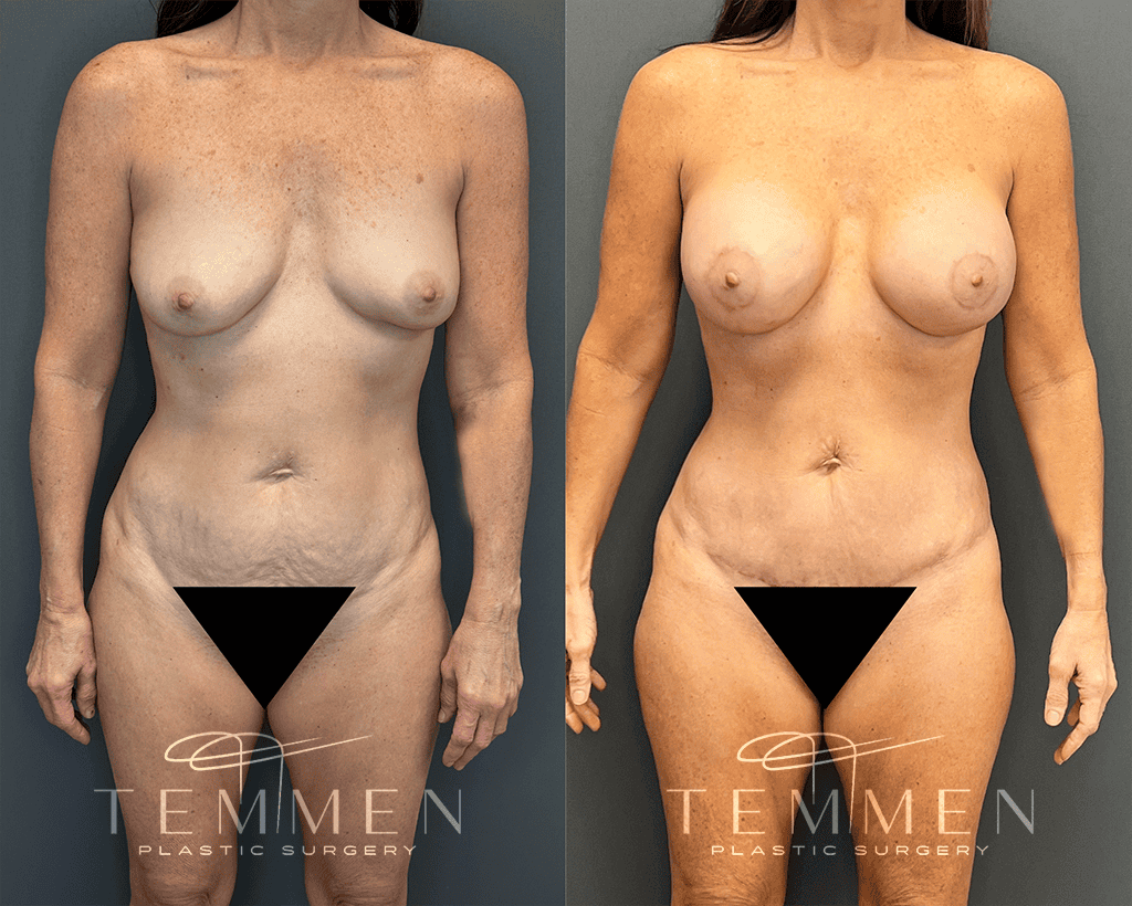 Mommy Makeover Before & After