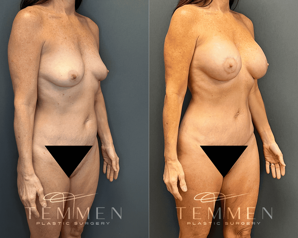 Mommy Makeover Before & After