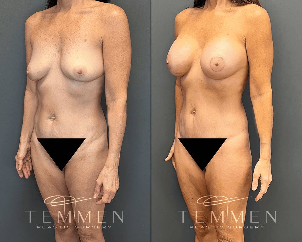 Mommy Makeover Before & After