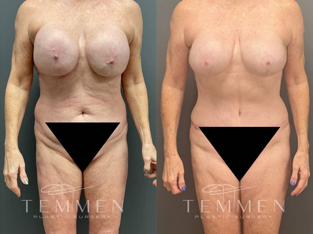 Mommy Makeover Before & After