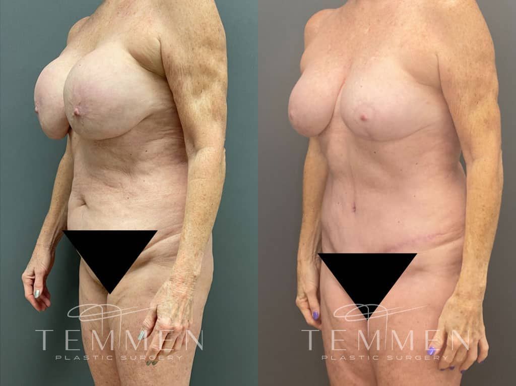 Mommy Makeover Before & After