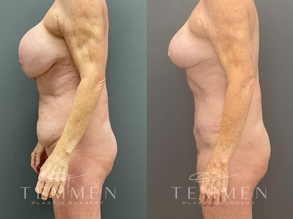 Mommy Makeover Before & After