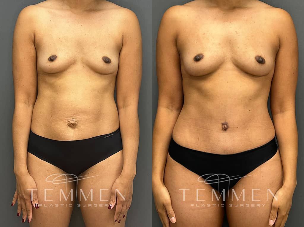 Mommy Makeover Before & After