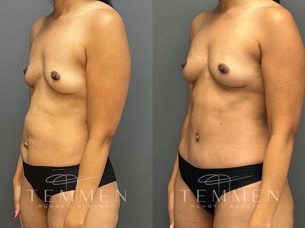 Mommy Makeover Before & After