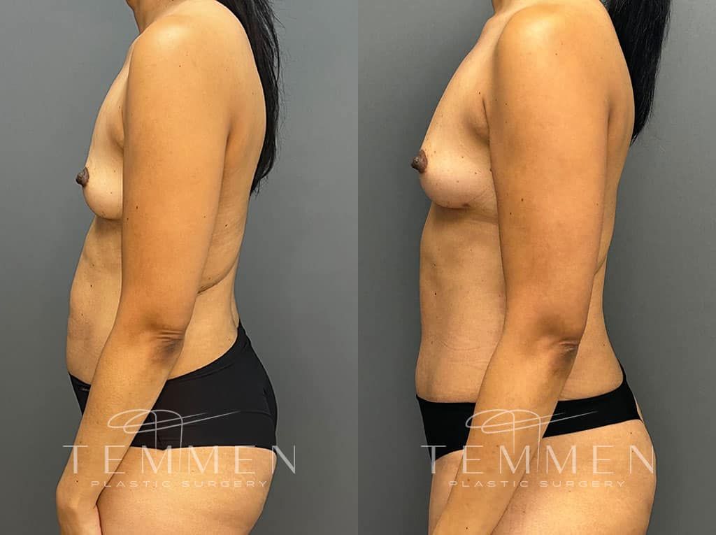 Mommy Makeover Before & After