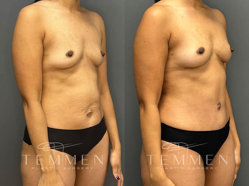 Mommy Makeover Before & After