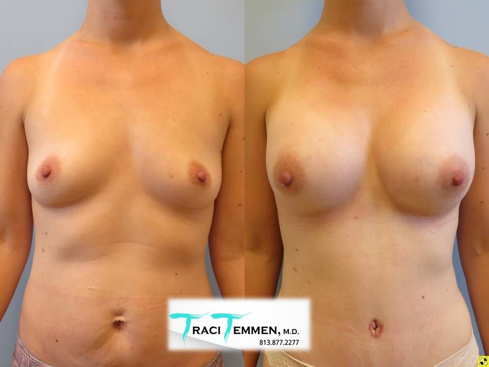 Mommy Makeover Before & After