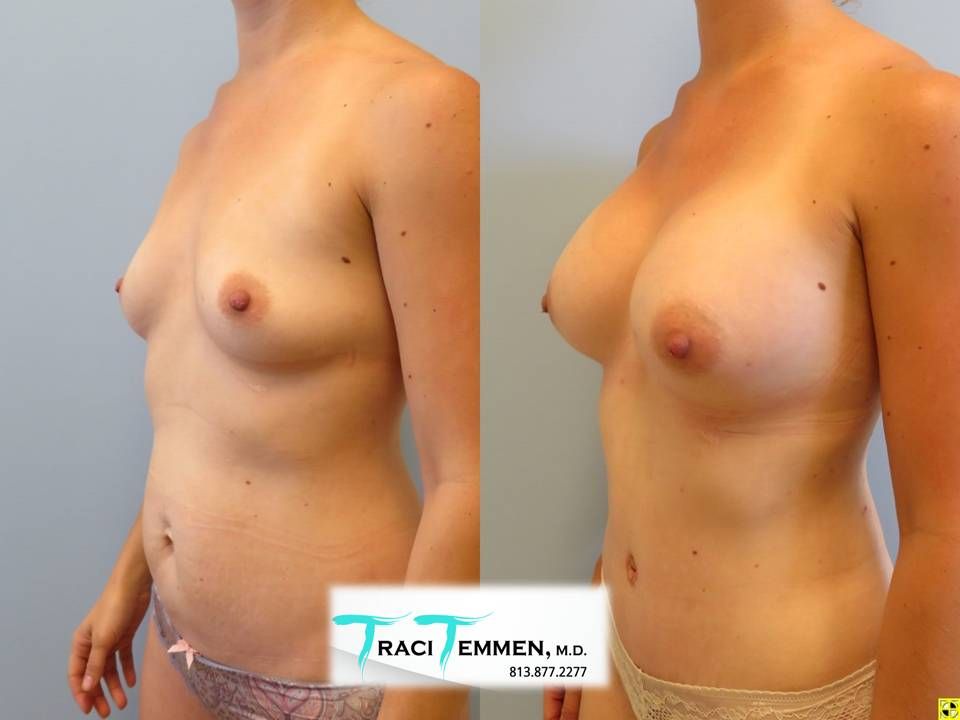 Mommy Makeover Before & After