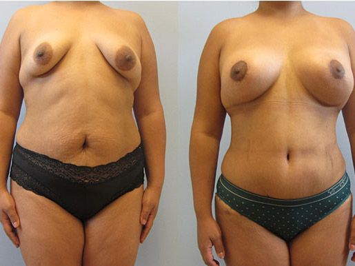 Mommy Makeover Before & After