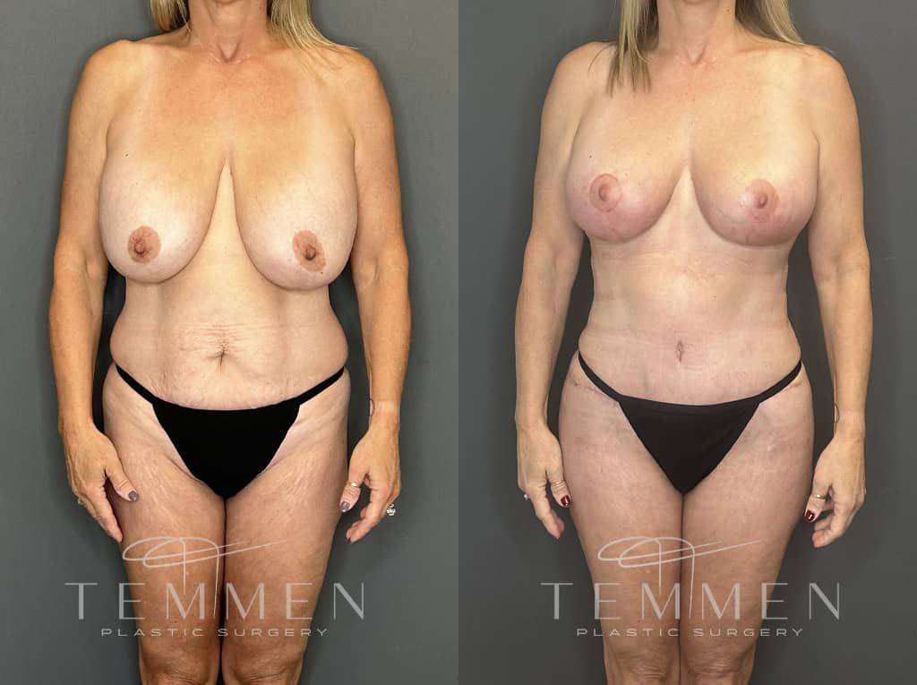 Mommy Makeover Before & After