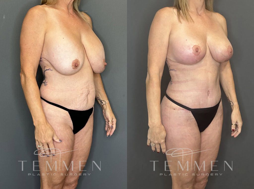 Mommy Makeover Before & After