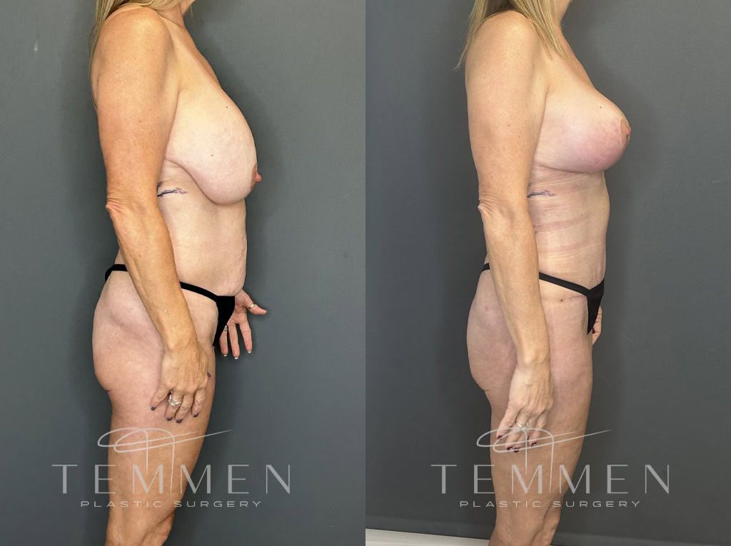 Mommy Makeover Before & After