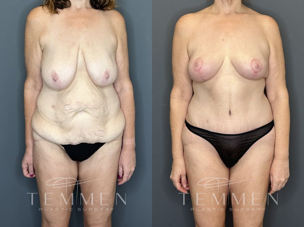 Mommy Makeover Before & After