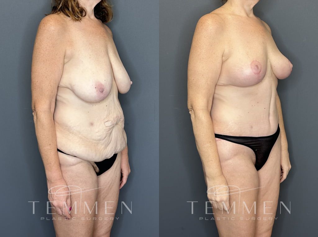 Mommy Makeover Before & After