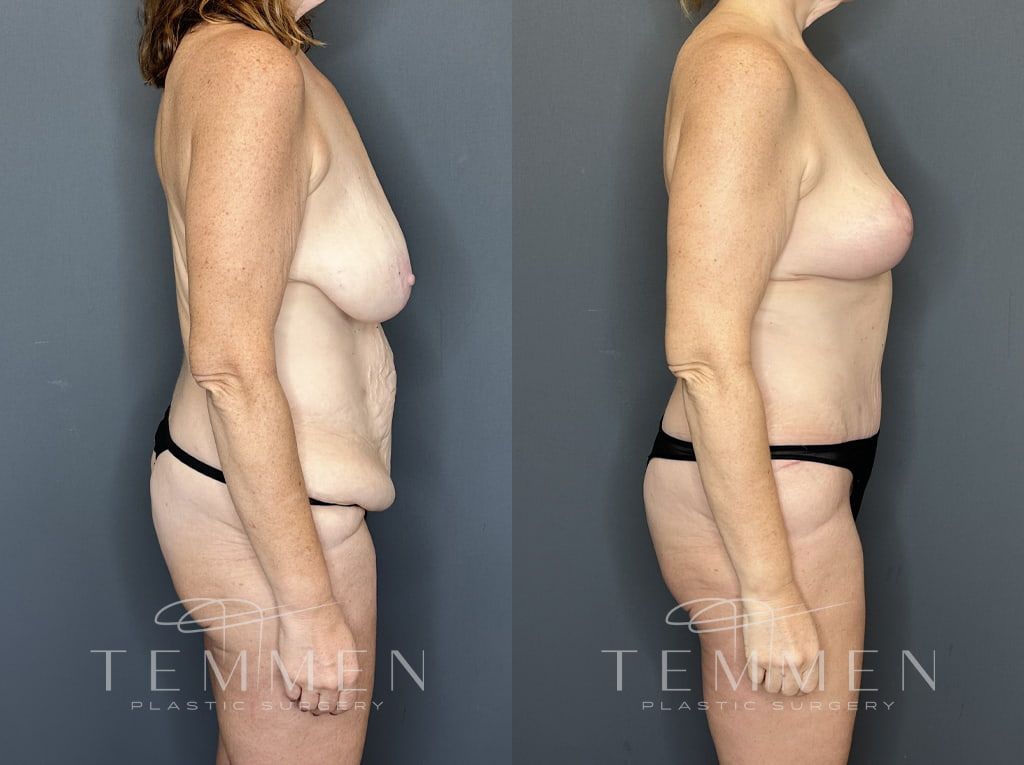 Mommy Makeover Before & After