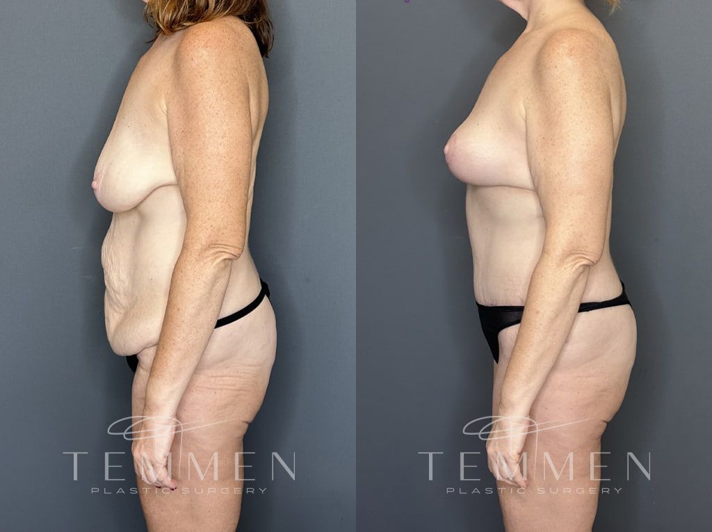 Mommy Makeover Before & After