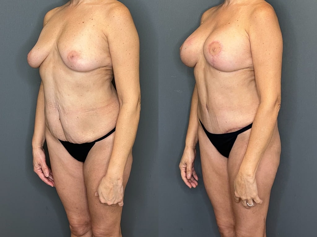 Mommy Makeover Before & After