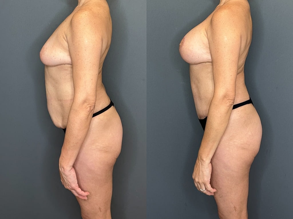 Mommy Makeover Before & After