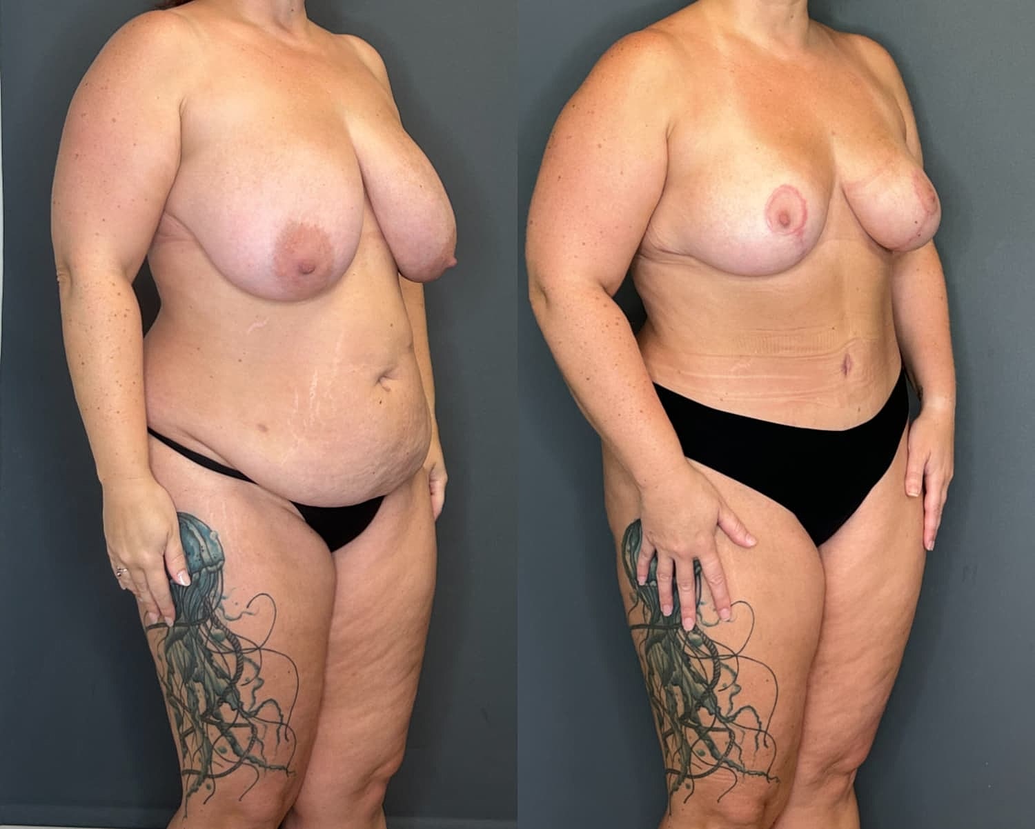 Mommy Makeover Before & After