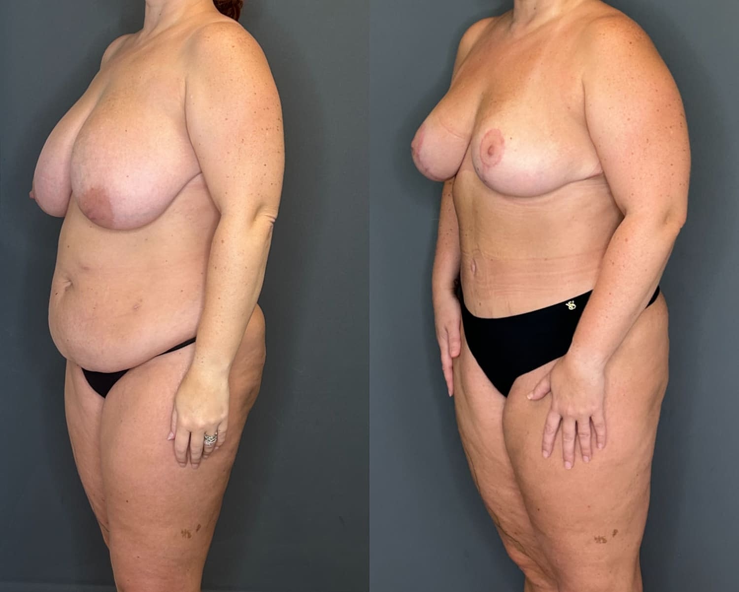 Mommy Makeover Before & After