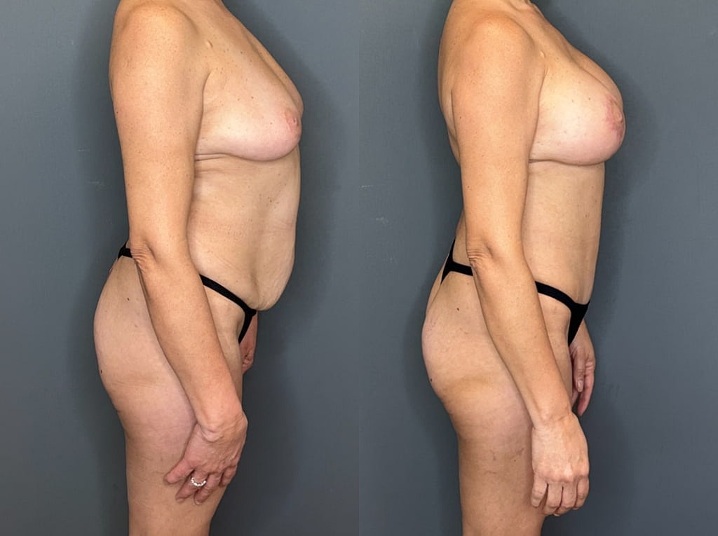 Mommy Makeover Before & After