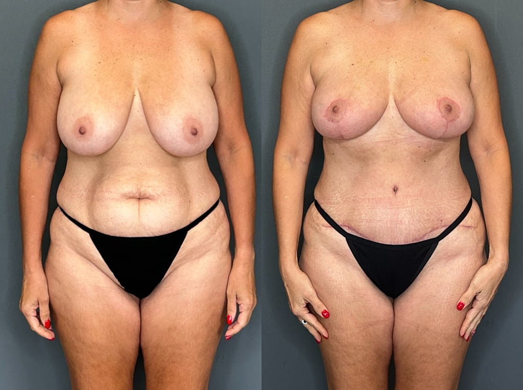 Mommy Makeover Before & After