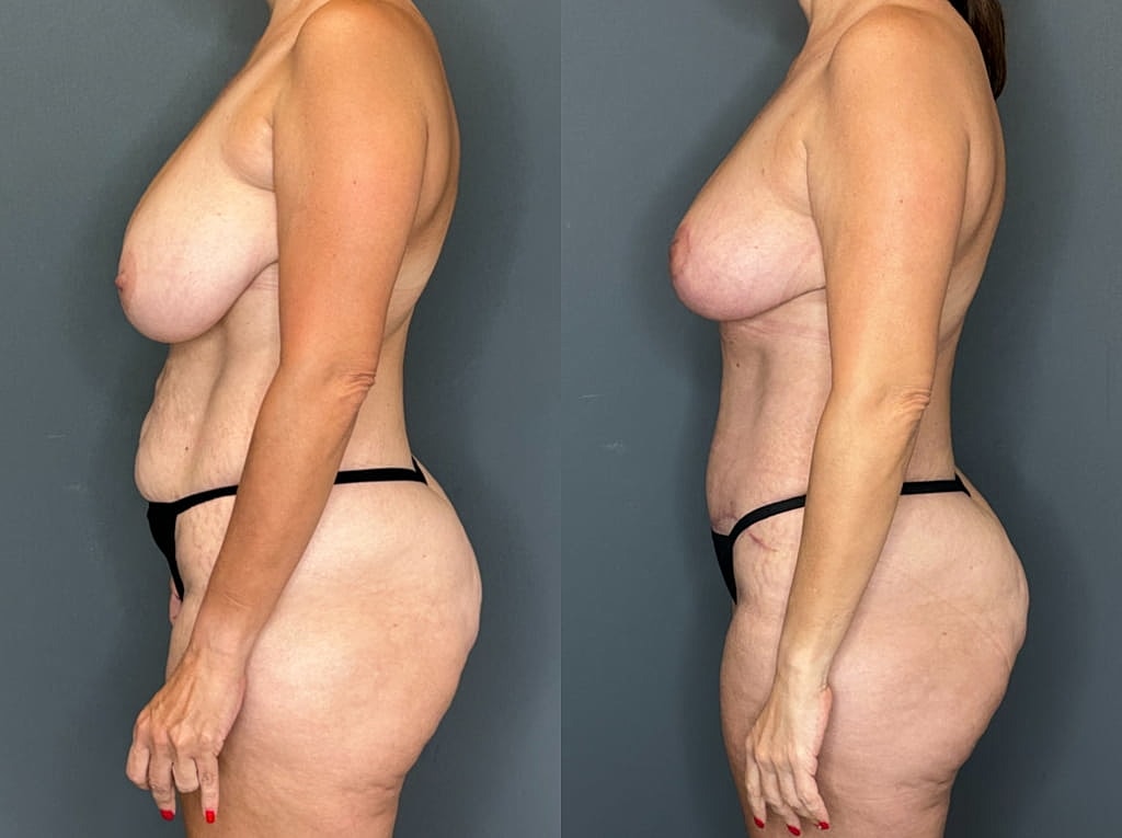 Mommy Makeover Before & After