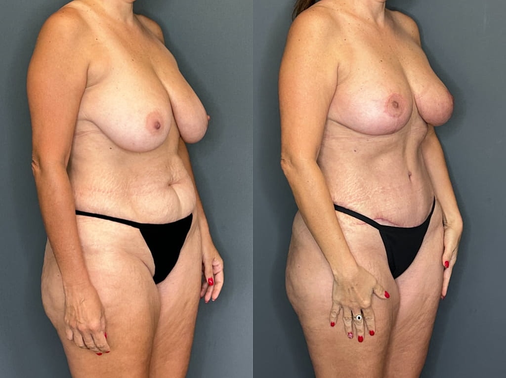 Mommy Makeover Before & After