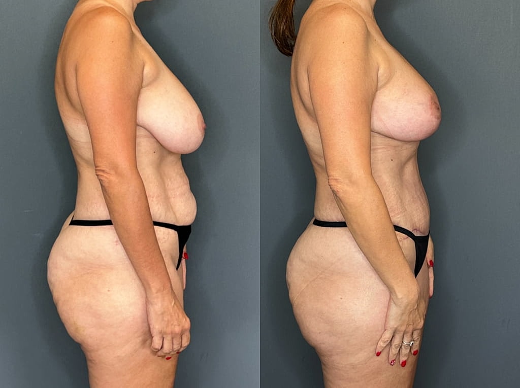 Mommy Makeover Before & After